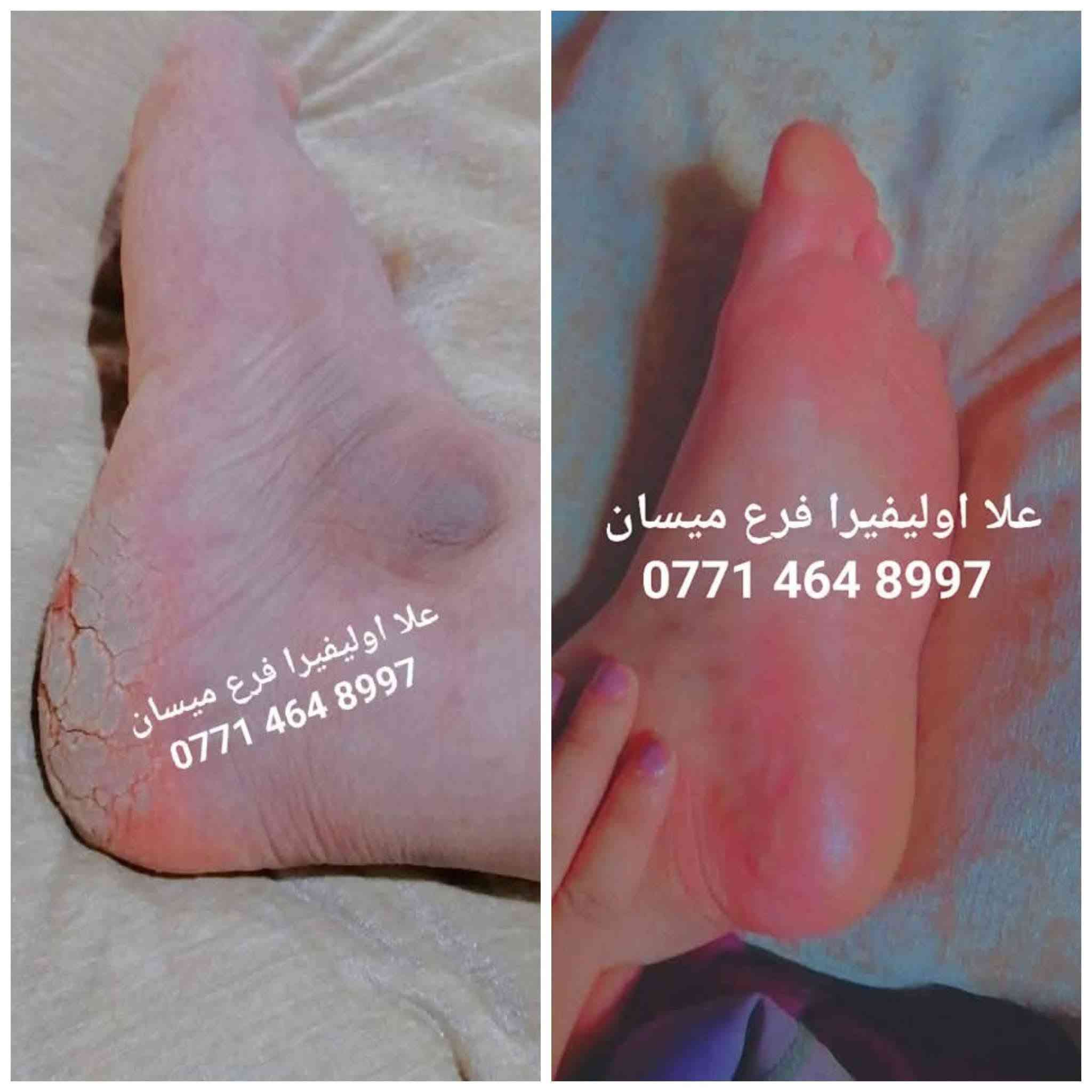 سبب حرارة الصيف واغلبيتنه راح نعاني من تشققات الاقدام وخشونتها بسبب الحراره 😞 ولا يهمكم حبايبي جبتلكم كريم علا اوليفيرا السحري المعجزه بكج كامل 🌟الي راح يخلي اقدامكم نااعمه مثل اقدام الاطفال 💎

نص مكتوب في الصور:
- +964 773 877 *********** شوفى رجلينه كلش جانت يصبن دم والله العضيم ٣ ايام خليته اله العلاج وتعالجن رجليه حتى لايده خليت صارن كلش زينات ***********97
- +964776591
- ***********
- BAN
- علا اوليفيرا!
- بان مهدي صالح
- 077
- مراسلة
- علا اوليفيرا فرع ميسان ***********
- +9647732591 *********** علا اوليفيرا ٠٥:١٧ ص بان مهدي صالح شوفي الفرق ٠٥:٢٢ ص خيه انتي رحمه من الله انطاج النه ايدج وعلاجج بي العافيه ٠٥:٢٣ ص صباح الورد ٠٥:٢٩ ص صلوات عل . محمد هآا . محمد مراسلة
- علا اوليفيرا فرع ميسان *********** هاي قبل العلاج علا اوليفيرا فرع ميسان *********** علا اوليفيرا فرع ميسان *********** هاي بعد االعلاج
- وردة
- نشط الآن
- ٧:٥٩ م
- السلام عليكم
- شخبارج
- حبيت اشوفج الفرق
- ***********
- قبل
- بعد
- علا اوليفيرا فرع ميسان
- ربي يرزقكم ان شاء الله
- ٨:١٩ م
- اللهم صلي على محمد وآل محمد
- لقد قمت بالرد على وردة
- وعليكم السلام ياقلبي
- Aa
- +964 77 2599
- ايي هم نسيت ٠٩:٣٤ م
- ***********
- هاي رجليه اليوم ٠٩:٣٤ م
- بعد استخدام مره وحده ٠٩:٣٥ م
- احسن صار ٠٩:٣٥ م
- صارن ٠٩:٣٥ م
- لصق
- مرحباً! أنا استعمل واتساب. +964 77 علا اوليفيرا فرع ميسان *********** اللهم صلي على محمد وآل محمد اخذت صوره من كلتيلي قبل ماستخدم الخلطه وعلي جان اليل ماينام من الوجع كلساعه يذب عليهن ماي لان يبسن ويشككن بس يدوس بلكاع يطكن دم وعلي نندعيلج وهوه يكول ادعي للمربه لسوتلي رجليه زينات علا اوليفيرا فرع ميسان *********** ياعمري ان شاءالله اكون عند حسن ظنكم يارب ومليون عافيه الكم ياعمري احلى شعور من تراسلوني وانتم فرحانين مراسلة
- علي اولفيرا فرع
- ميسان
- شوفي النتيجه