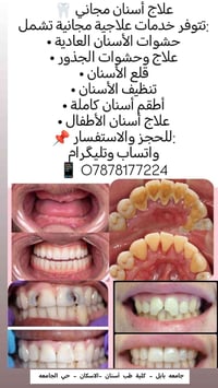 علاج أسنان مجاني • جامعة بابل • علاج أسنان الأطفال