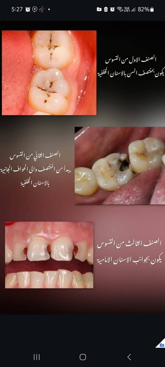 تنظيف الأسنان • إزالة التكلسات • جامعة اوروك