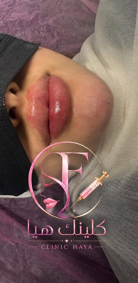 كلينك هيا للتجميل clinic Haya للحجز والاستفسار 
***********
مسويلكم عروض اجنن بنات
