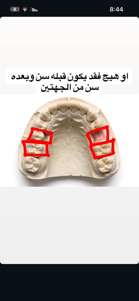اي حاله عندكم او عند أقاربكم تكدرون تتواصلون خاص للمعالجه + حالات قلع الأسنان والجذور المتبقيه الحجز للأسبقية والعلاج مجاني عدا التعويضات ب اسعار بسيطه

نص مكتوب في الصور:
- احد من اهلكم عنده هيج فقد بأسنانه؟ او شي مشابه لهاي الحاله
- او هيج فقد يكون قبله سن وبعده سن من الجهتين
- او هيج فقد يكون سن واحد او سنين من الاسنان الاماميه
- اذا عندك وحده من هذه الحالات تواصل معي تسوس بسطح السن تسوس بين الاسنان تسوس قريب اللثة كسر بالاسنان