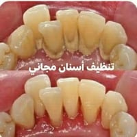 تنظيف أسنان • مجاني • غدا ١٠ص