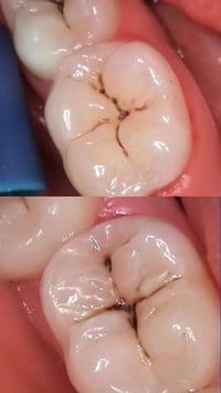 تسوس • علاج مجاني • تواصل خاص
