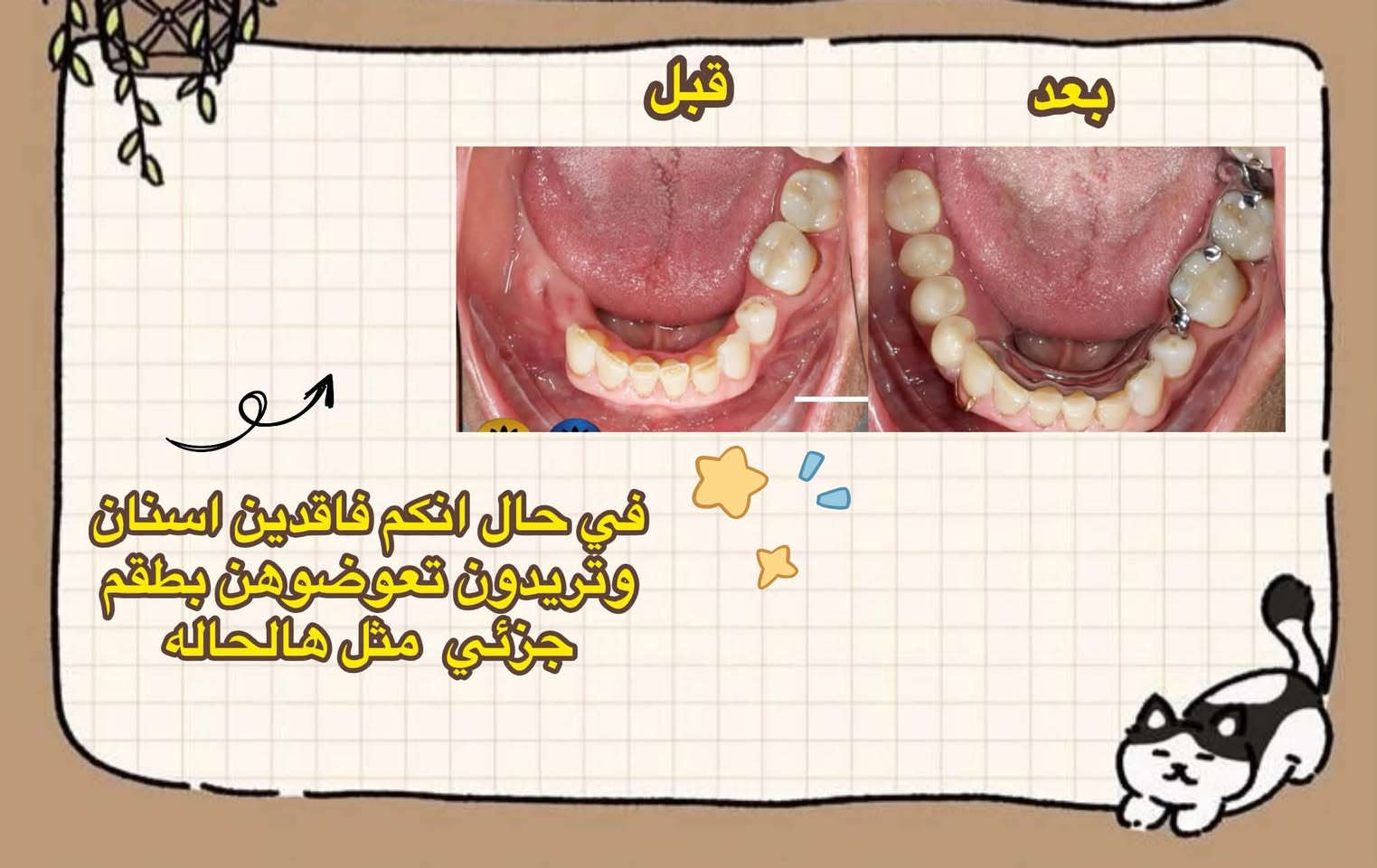 اهتموا بابتسامتكم، والبداية من صحة أسنانكم 🦷✨
تتوفر خدمات علاجية متنوعة ضمن العيادات
الجامعية، منها:
حشوات الأسنان
اقلع الجذور
ا تنظيف التكلسات ا
أطقم الأسنان
(العلاج يتم داخل العيادات الجامعية وتحت إشراف)
الكادر المختص.
للتفاصيل والاستفسار، التواصل عبر الرقم / واتساب
+964 789 158 6853
***********

نص مكتوب في الصور:
- الحالات اللي نستقبله
- التسوسات العاديه
- السن انكسر وضل عندك جذر متبقي
- قبل بعد في حال انكم فاقدين اسنان وتريدون تعوضوهن بطقم جزئي مثل هالحاله
- و تنظيف التصبغات اكيد