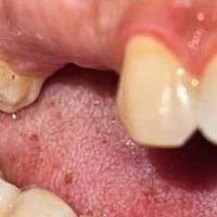 تخم جزئي • سن مفقود • واتساب