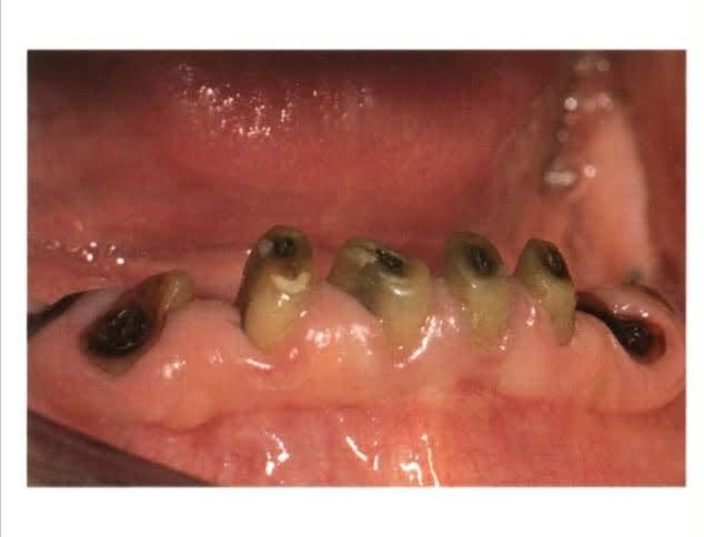 خلع سن • علاج مجاني • مستشفى طب الاسنان