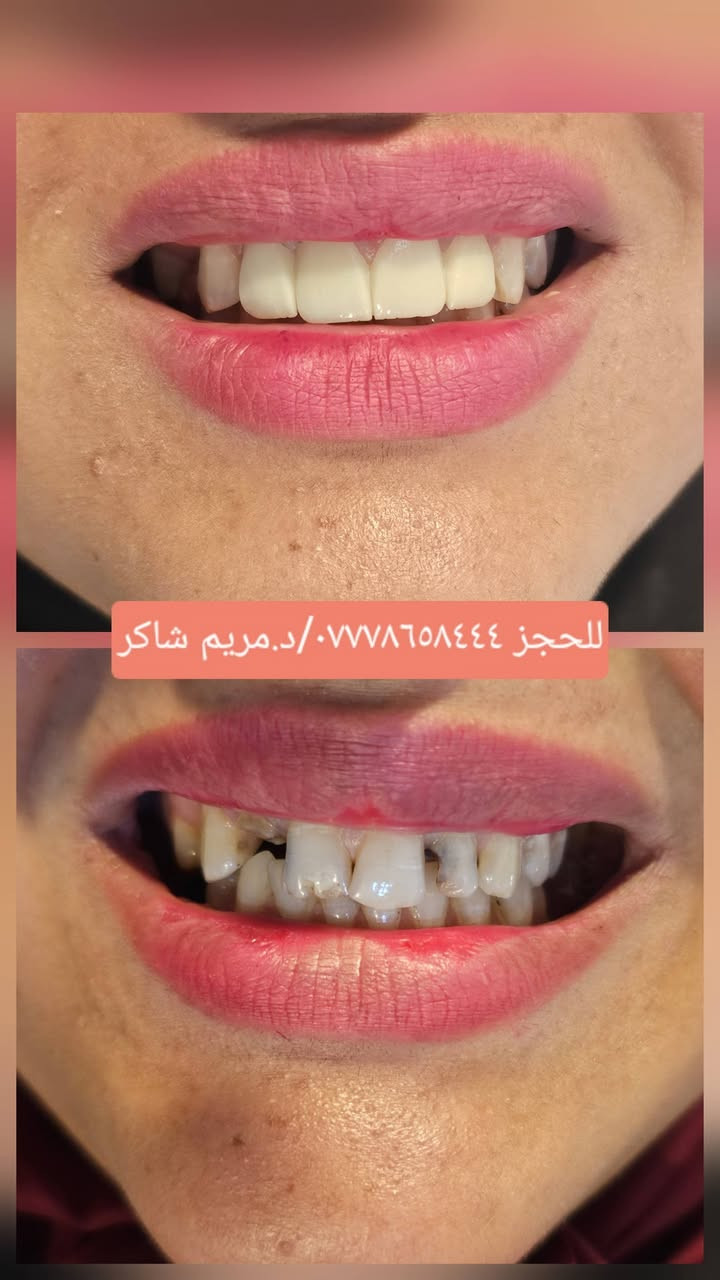 مراجع يعاني من فقدان وعدم انتظام الاسنان ...تم عمل خطة علاجية واكساء الاسنان بتركيبات الزاركون الثابتة ليكتسب ابتسامة رائعة ومشرقة 
د.مريم شاكر محمود 
للحجز ☎️☎️واتس ***********
حي الفارس /الشارع الرئيسي/قرب محطة وقود الفارس /مقابل اسواق جدو🦷🤍
