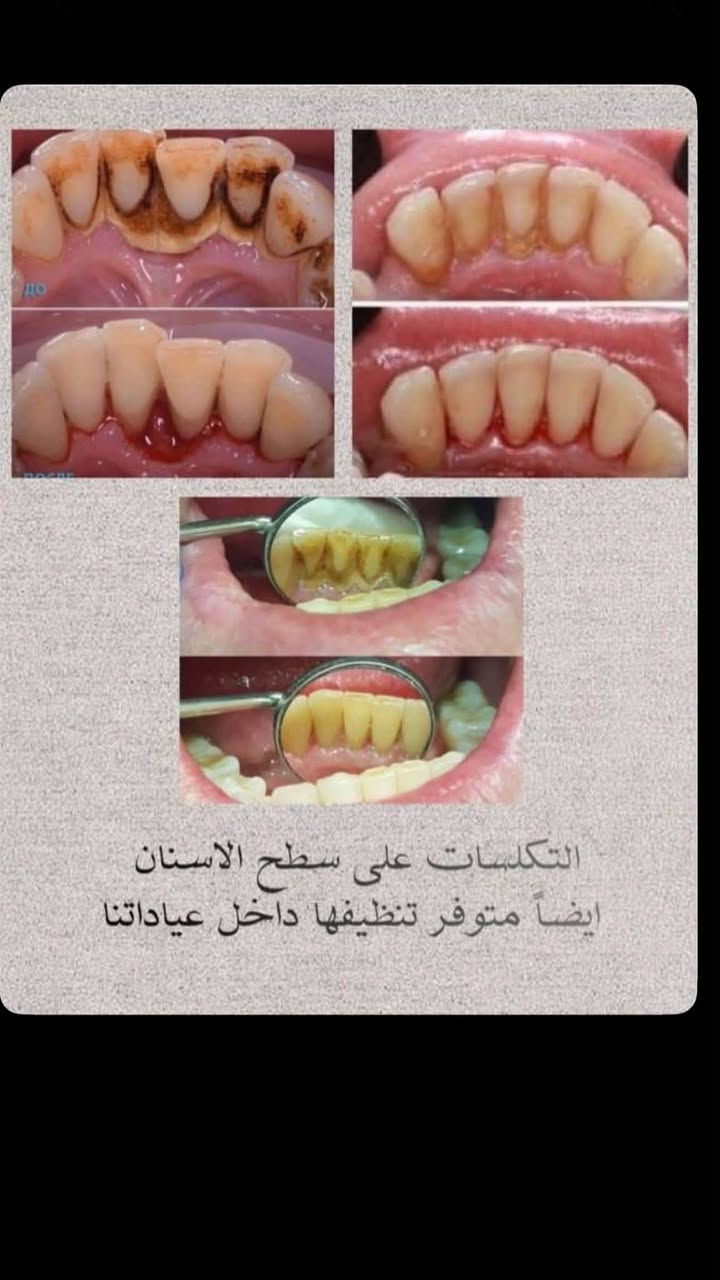 دكتورة آيات • طقم أسنان • قلع أسنان