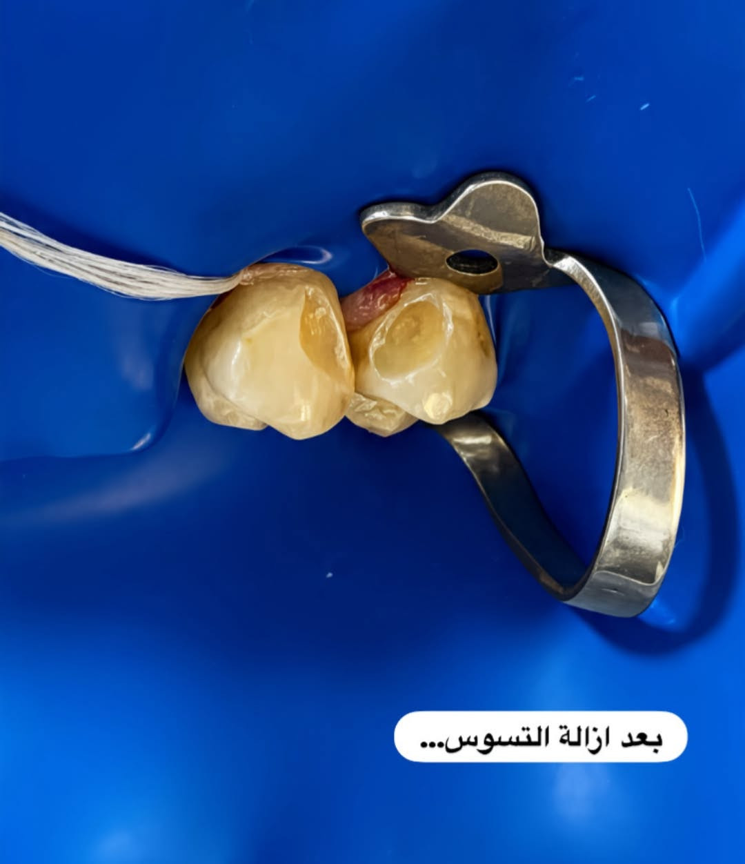تسوس الأسنان الأمامية مو بس يسبب ألم... يأثر مباشرة على ضحكتك وثقتك بنفسك. 🦷✨
 هاي الحالة المراجعة عدها تسوس بالأسنان الأمامية؛ كان زاعجها لدرجة ماتقدر تبتسم لان التسوس يخرب ابتسامتها 
، تم تنظيف السن بالكامل ورممنا السن  بحشوة ضوئية (تجميلية) بنفس لون السن الطبيعي تماماً، بحيث ترجع الابتسامة طبيعية وبدون أي أثر للترميم✨

ولأن الابتسامة هي جزء أساسي بثقتك بنفسك وهي أول شيء ينتبه له المقابل💫  لا تهمل اي تسوس يخربها ويقلل ثقتك بنفسك

📩 للتواصل وحجز موعد، تقدرون تراسلوني على الخاص
او على الرقم   ***********
📍العيادات التعليمية لطب الاسنان في جامعة المعارف 
كلية طب الاسنان - جامعة المعارف
الدكتورة رانيا ماجد /طالبة طب اسنان مرحلة خامسة
 تقدرون تشوفون شغلي على صفحتي بالإنستغرام ranya_majed28
