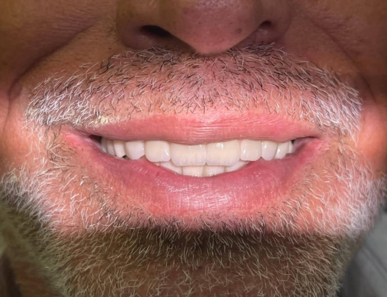 ✨ ابتسامة جديدة… تبدأ بخطة علاج متكاملة ✨
في هذه الحالة تم إجراء:

🦷 تبديل الجسر.
🦷 حشوات بناء.
🦷 علاج جذور (سحب عصب).
🦷 زراعة الأسنان.
🦷 تنظيف شامل وتأهيل كامل للفكين.

✅ تم إنجاز هذا العلاج بالكامل في جلسة واحدة وفق خطة علاجية متكاملة.

🎁 عند علاج عدة أسنان، يحصل المريض على جلسة تنظيف مجانية.

🤍 النتيجة… ابتسامة صحية، طبيعية، وثقة أكبر.
شاهدوا الفرق بين قبل وبعد.

📍 عيادة الدكتورة زينب مازن القيسي
السيدية – شارع الخيزران – مقابل مدرسة الأقصى الأهلية للبنين – بناية أرض بنان الرصاصية.

📞 ***********
