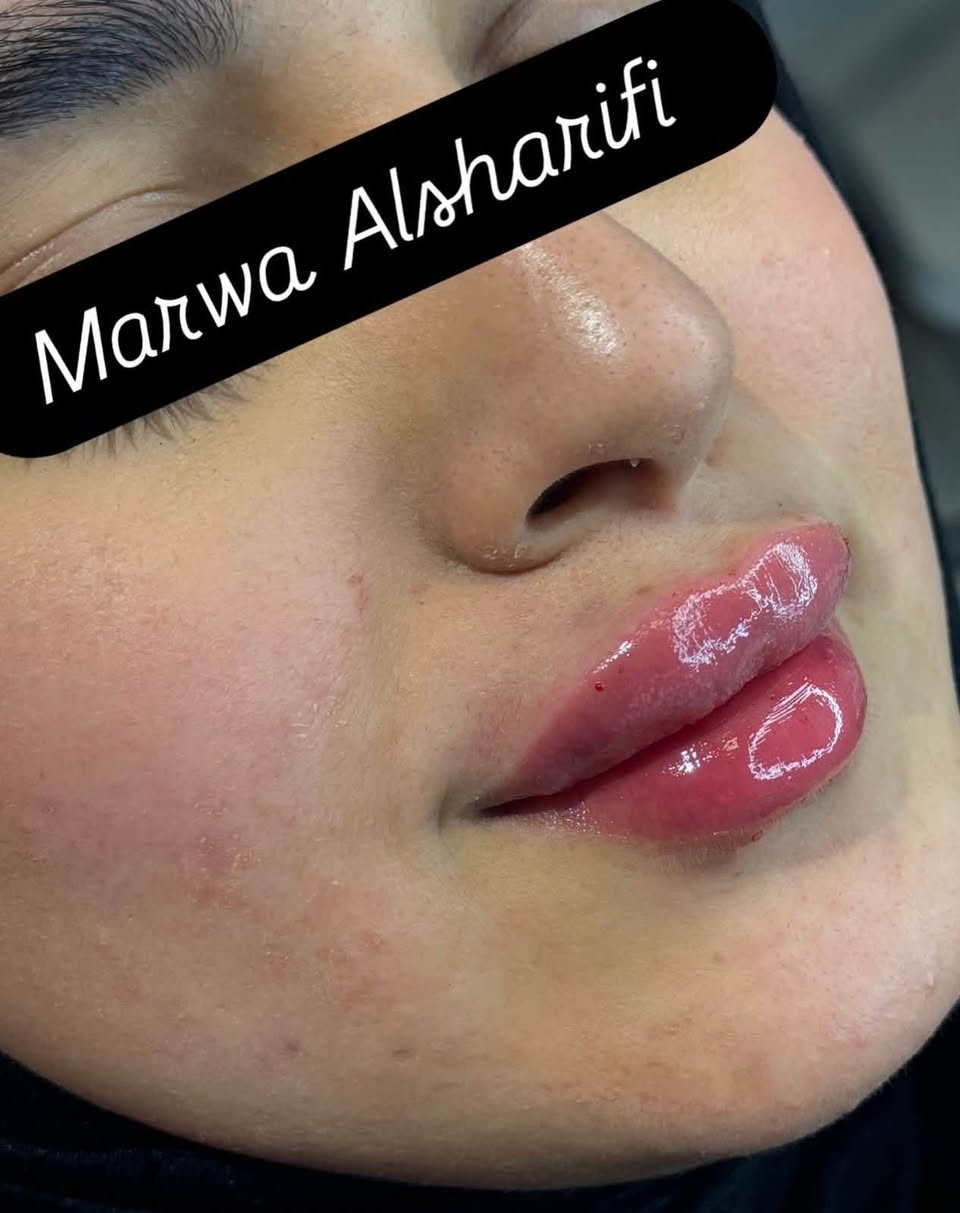 فلر شفه من تكون الرسمة على ايد مروة الشريفي  هيج تكون النتيجة 🍒💉للحجز دايركت او لاتصال على هذا الرقم *********** Marwa Alsharifi
