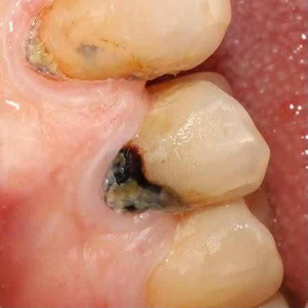 نعلن عن تقديم خدمات طب الأسنان مجاناً وتشمل:
   • قلع الأسنان والجذور المُتبقية   
* حشوات ضوئية دائمة  
* تركيب طقم جزئي للأسنان 
* تنظيف الأسنان 

📍جامعة الزهراوي -طريق نَجف كَربلاء -مُقابل عمود 1111

📌 الخدمة مجانية  
📞 للحجز والاستفسار، يرجى التواصل معنا على الخاص ***********

صحتكم وابتسامتكم تهمنا..
