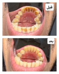 تنظيف الأسنان وإزالة التكلسات في العيادة مو بس لبياض الأسنان، بل خطوة ...