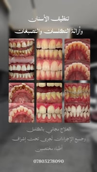 علاج مجاني • حشوات تجميلية • طقم جزئي