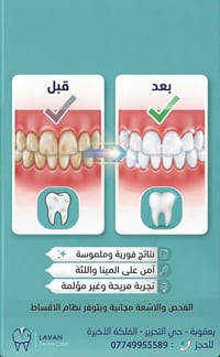 تبييض أسنان • عيادة لافان • بعقوبة
