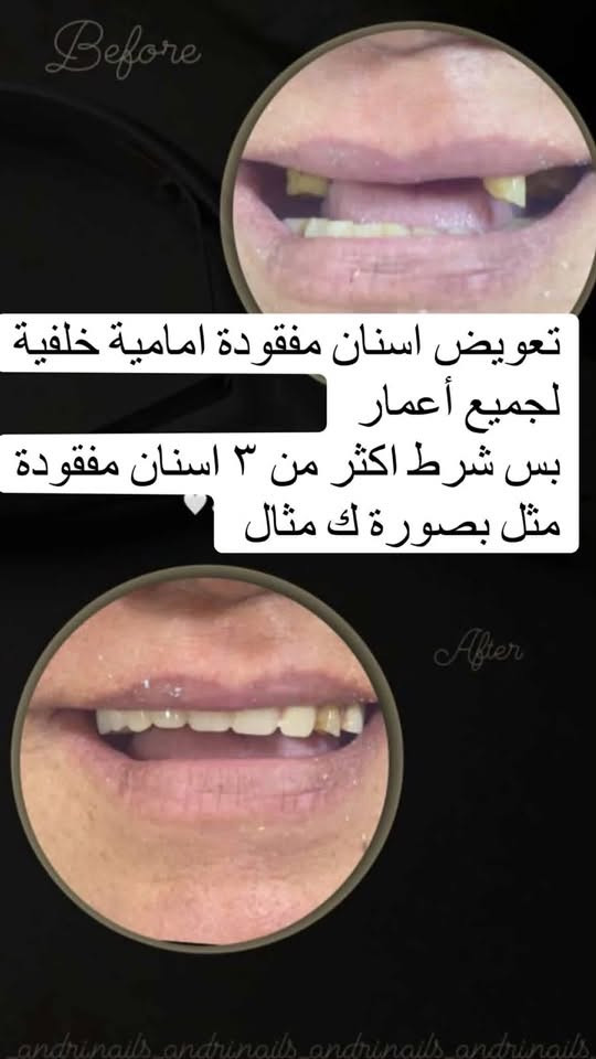 السلام عليكم علاج مجاني بالكامل
وبأفضل الأدوات تتم المعالجة وتحت إشراف أطباء أختصاص   للحالات الاتية :

الي عنده حشوات امامية وخلفية  تجميلية أسويهم 

وقلع اسنان وبقايا جذور

تنظيف اسنان وازالة التكلسات 

طقم جزئي متحرك 

العنوان ب يرموك كلية الحكمة 

تفاصيل اكثر ع هذا رقم واتساب

***********
