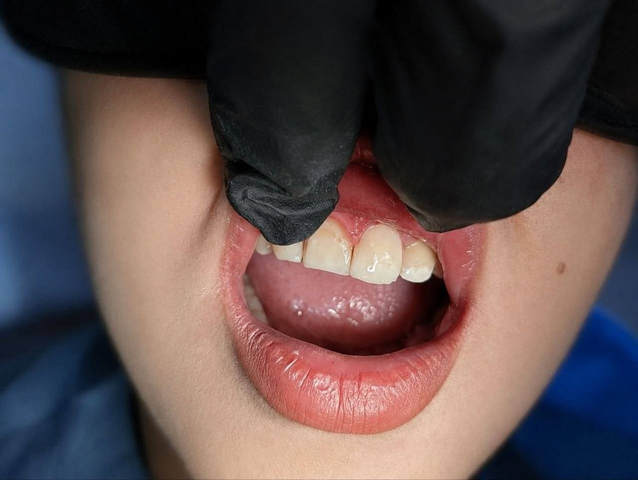 كل هذه الحالات تمت معالجتها بحشوات ضوئية
وبصورة مجانية 

للتواصل عن طريق الرقم

 ***********
