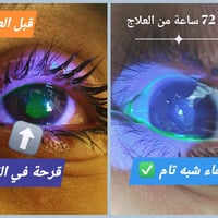عدسات لاصقة • طبيب عيون • عيادة المسيب