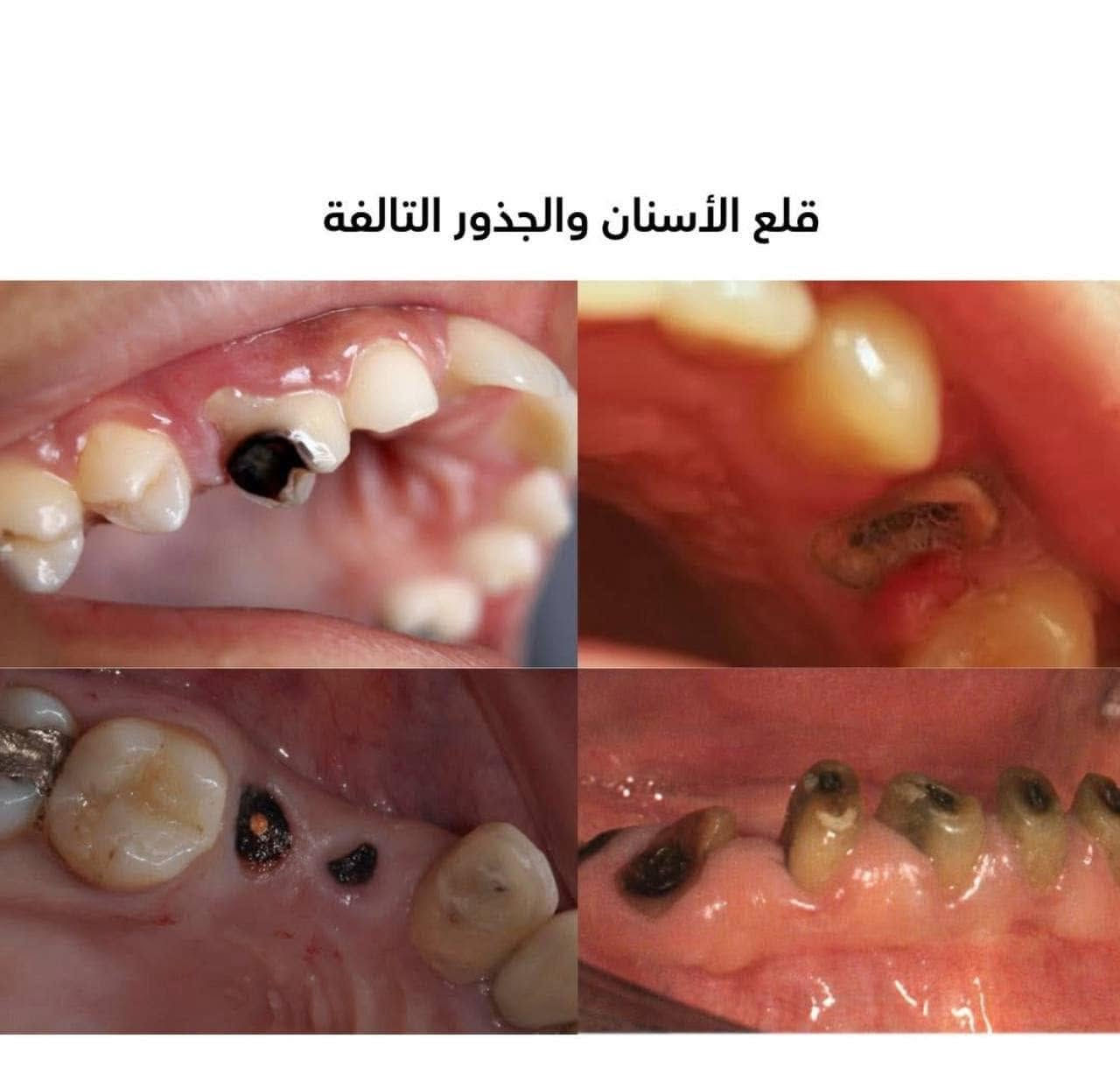مرحبا متوفر معالجة لِـ :
_ قلع الاسنان والجذور التالفة
_ ازالة التسوسات وتعويضها بحشوات ضوئية .
  _ تعويض الاسنان المفقودة بطقم كامل متحرك .
_ تنظيف الاسنان وازالة التكلسات .
_ حشوات جذرية للاسنان الامامية 
في عيادات جامعة المشرق
 
 العلاج مجاني

العنوان _ بغداد _ شارع المطار _ جامعة
المشرق
تواصل واتساب : ***********

نص مكتوب في الصور:
- تعويض الأسنان المفقودة بطقم جزئي متحرك
- تنظيف الأسنان وأزالة التكلسات
- علاج تسوس الأسنان بالحشوات الضوئية للحفاظ على أبتسامة صحية وجميلة
- قلع الأسنان والجذور التالفة