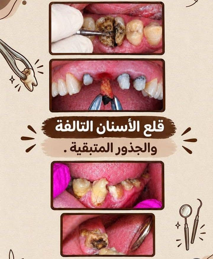 علاج مجاني • عيادات جامعة واسط • تعويض أسنان