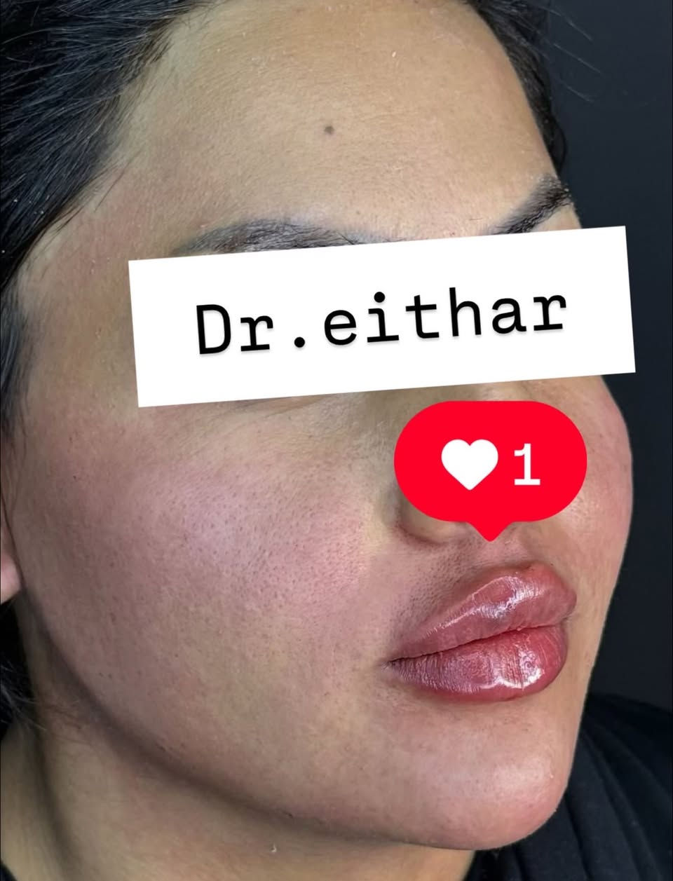 كونتور الوجه بالفلر  (لفتنك وجنات  واصداغ وتدوير الفك والذقن ونظاره وشفة ) 🔥🔥
لاحضو الفرق بالذقن ومنطقه الفك والوجنات شكد تغير الشكل🔥
عروووض للكادر التدريسي والخريجات والموظفات والعروسات  ثبتتهه الكم بالستوري بالهايلايت وببوست اعلى الصفحة ✨✨

د.ايثار سامي عبد الامير
واسط الكوت الهوره مجمع القبطان طابق اول 

الحجز***********
