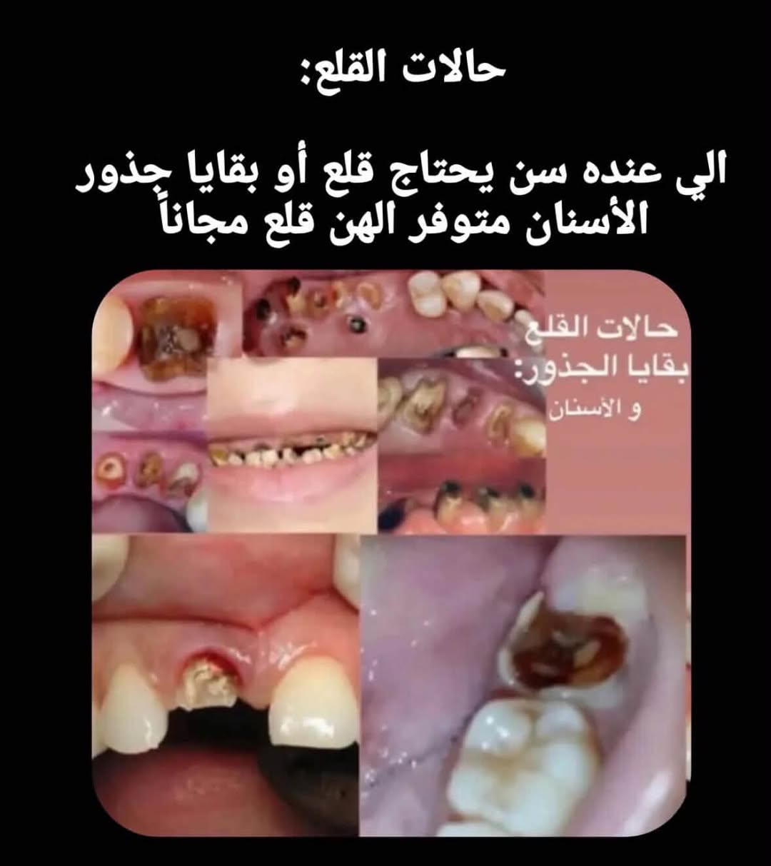 علاج مجاني • قلع أسنان • حشوات جذور