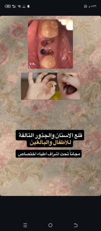 قلع اسنان • علاج مجاني • عيادات الجامعة الوطنية