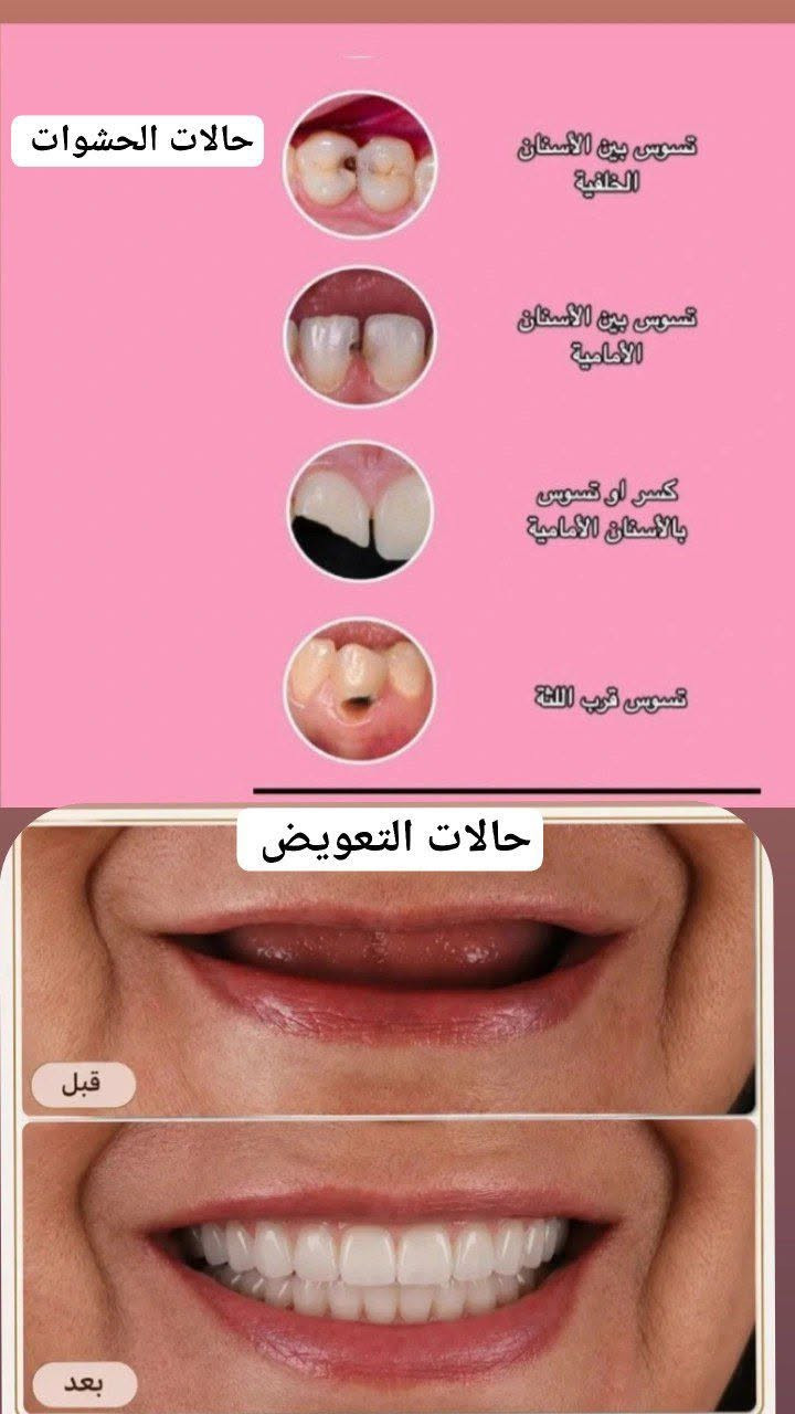 علاج اسنان مجاني • عيادات الجامعة الوطنية • قلع اسنان