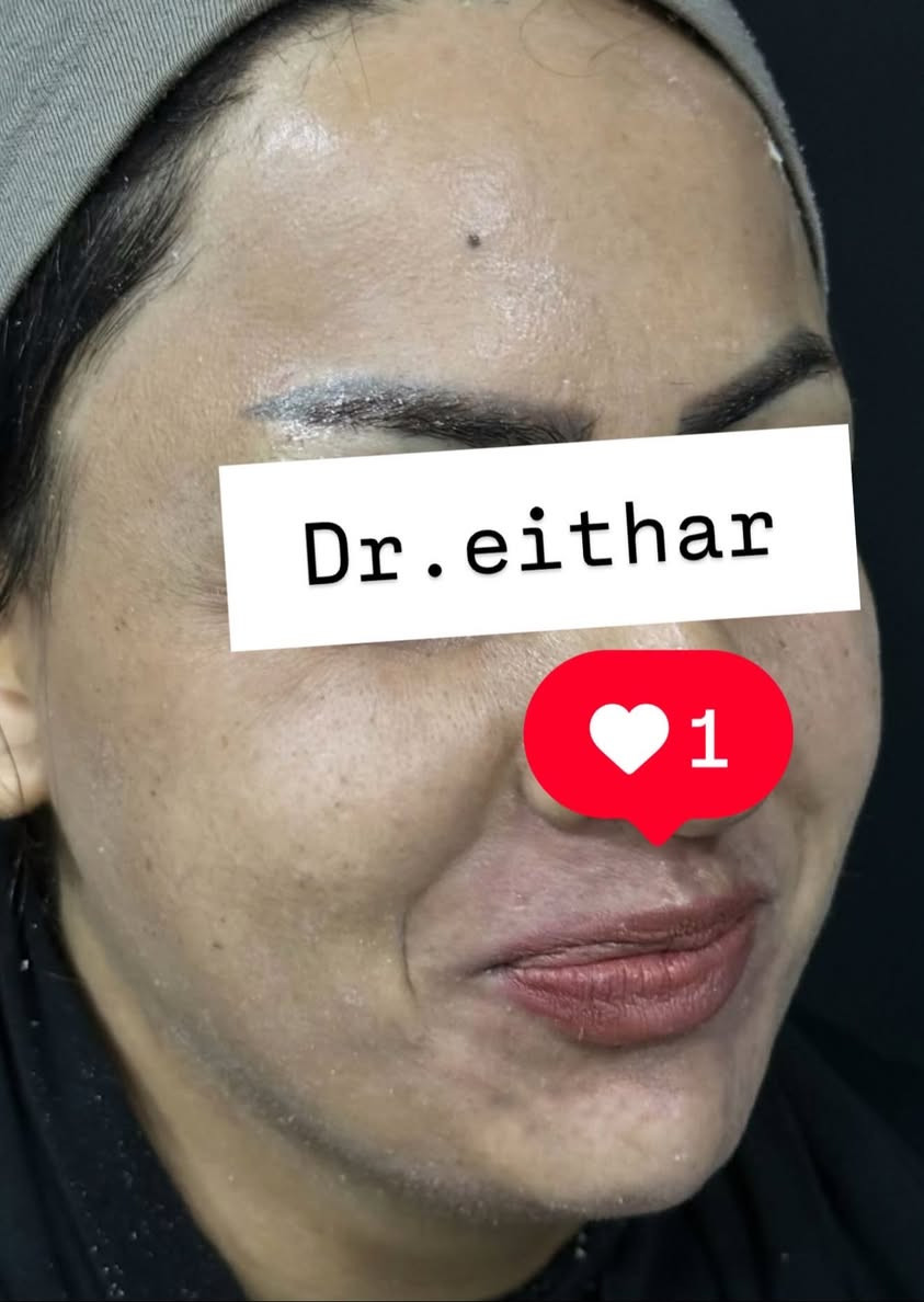 كونتور الوجه بالفلر  (لفتنك وجنات  واصداغ وتدوير الفك والذقن ونظاره وشفة ) 🔥🔥
لاحضو الفرق بالذقن ومنطقه الفك والوجنات شكد تغير الشكل🔥
عروووض للكادر التدريسي والخريجات والموظفات والعروسات  ثبتتهه الكم بالستوري بالهايلايت وببوست اعلى الصفحة ✨✨

د.ايثار سامي عبد الامير
واسط الكوت الهوره مجمع القبطان طابق اول 

الحجز***********
