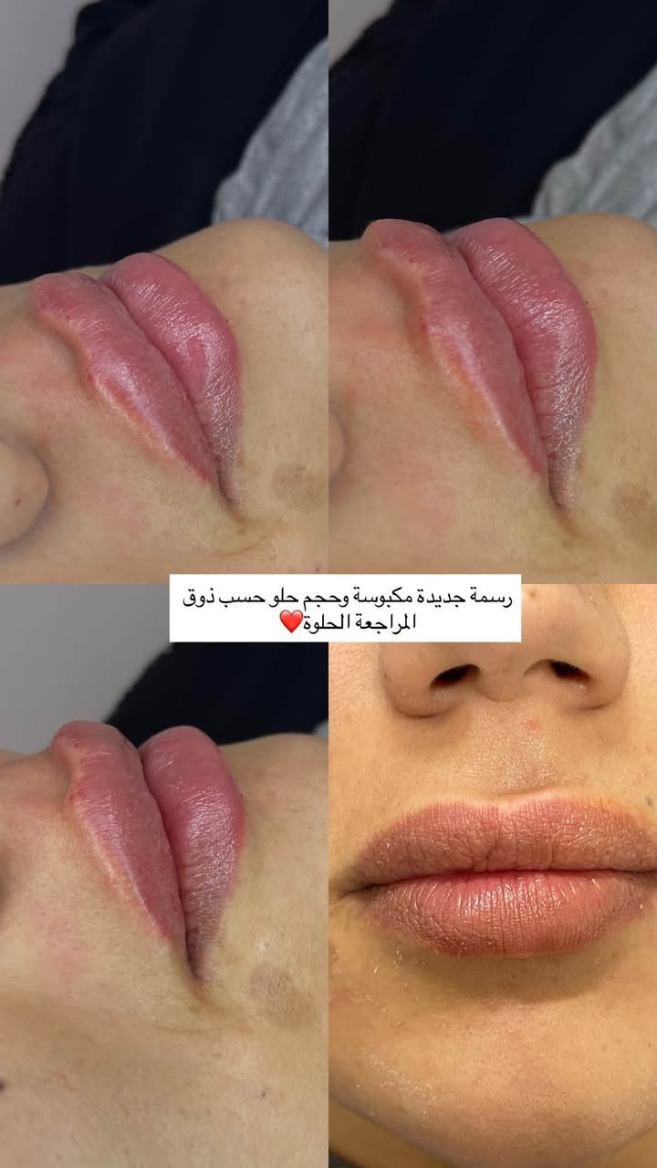 زيركون بسماية
نظام التقسيط يشمل جميع الاقسام وبدون مقدمة

والفحص مجانا 🥰

✨ جمالكِ مُهمتنا…..
شفايف منحوتة بعناية… امتلاء ناعم بدون مبالغة 💋
نتيجة طبيعية تخلي الكل يلاحظ بدون ما يعرف السر .

الدكتورة زهراء نجاح الحسيني حاصلة على سرتفكيت في تجميل الوجه اللاجراحي

علماً ان جميع المواد المستخدمة من براندات ووكالات عالمية ومرخصة من وزارة الصحة العراقية
———————————————————
بغداد-مقابل باب مجمع بسماية الالكتروني B الخدمي الراجع من بغداد عمارة كافي حنوش
مجاور صيدلية مريم عامر 

  للحجز+اسفسار
0775746377

#بسماية #تجميل #فلر

نص مكتوب في الصور:
- شكل شفة غير متناسق عدلنه التناسق وضفنه حجم حلو للمراجعة وطلعت باحلى صورة 🥰❤️
- بنات وفرتلكم احدث فلر كوري امتياز بعالم التجميل يبقى طري وينطي احلى رسمة ممكن تحصولها سعر العرض ب90 الف فقط 🔥❤️
- بعد قبل
- رسمة جديدة مكبوسة وحجم حلو حسب ذوق المراجعة الحلوة❤️
- لعناية وتجميل الأسنان