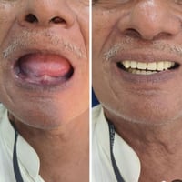 مجاناً • طقم أسنان • عيادات جامعة العميد
