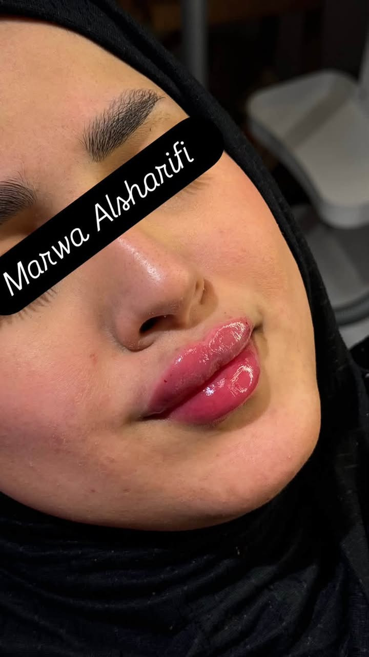 فلر شفه من تكون الرسمة على ايد مروة الشريفي  هيج تكون النتيجة 🍒💉للحجز دايركت او لاتصال على هذا الرقم *********** Marwa Alsharifi
