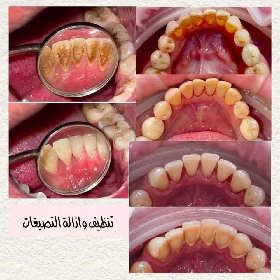 السلام عليكم...
نستقبل الحالات التالية في عيادات طب الأسنان

• تنظيف الأسنان من التصبغات و التكلسات

• حشوات تجميلية (ضوئية)

• قلع الأسنان و الجذور التالفة

 •تعويض الأسنان بالطقم الجزئي

العنوان : بغداد - الدورة-شارع 60

علما أن العلاج مجاني وتحت إشراف أطباء اختصاص.

للحجز والأستفسار:

***********

نص مكتوب في الصور:
- قلع الأسنان والجذور التالفة
- تنظيف وازالة التصبغات
- BEFORE
- تعويض اسنان
- طقم متحرك
- علاج تسوس الاسنان بحشوات تجميلة