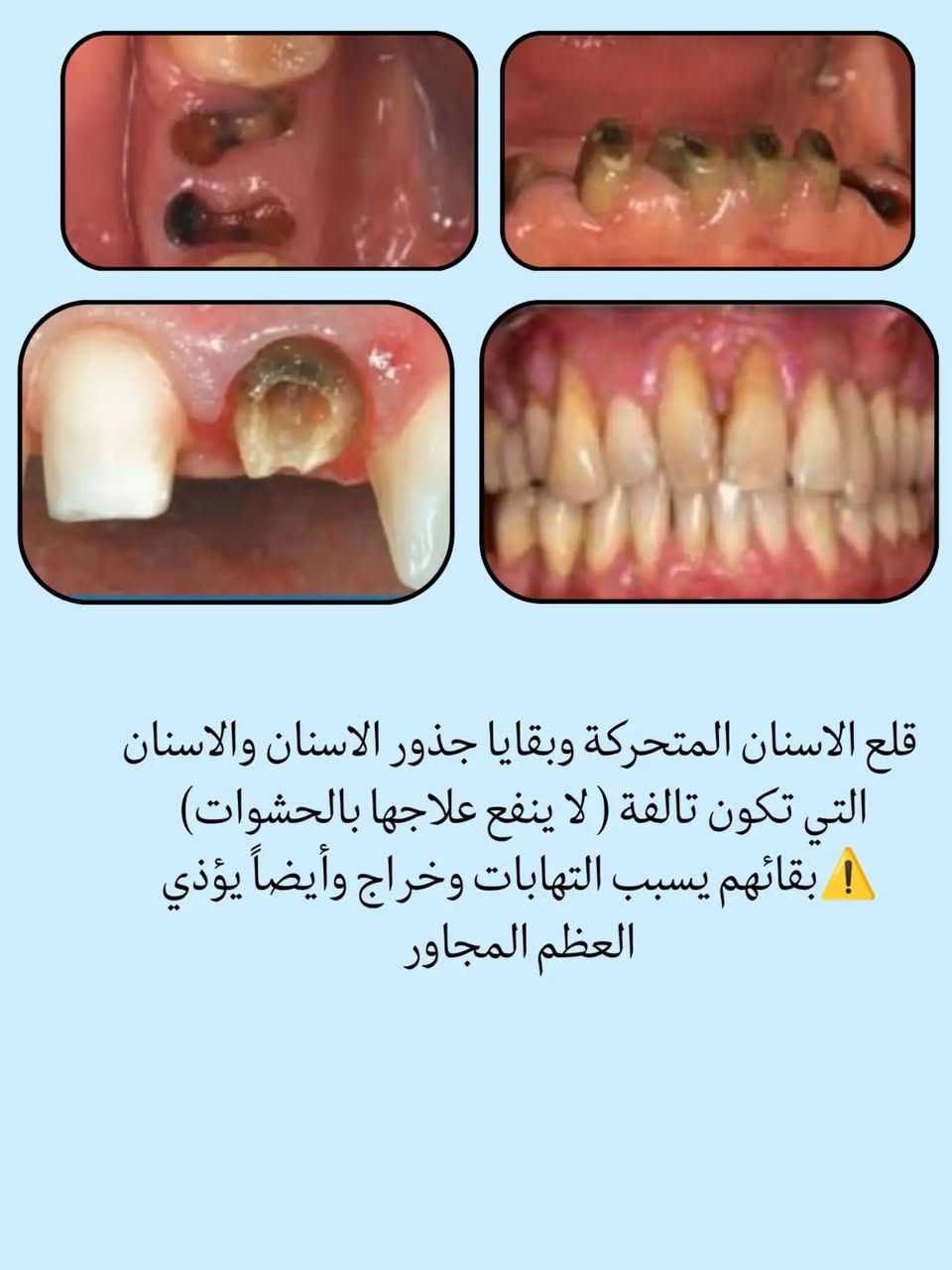 علاج مجاني • حشوات بيضاء • جامعة القادسية