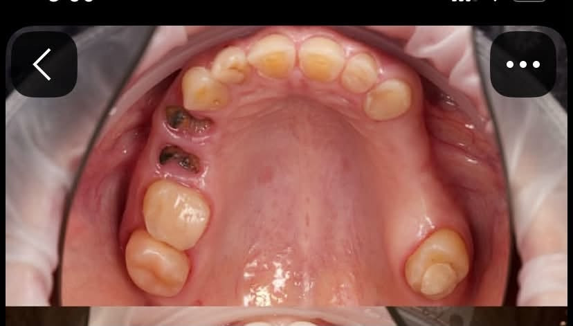 الرمادي • طقم اسنان متحرك • جامعة المعارف