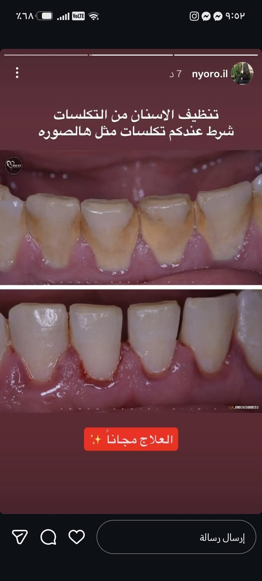 للتواصل واتساب ***********

نص مكتوب في الصور:
- تعلن كلية طب الاسنان في جامعة الهادي عن فتح عياداتها لاستقبال المراجعين لعلاج الحالات التالية:
- 1.حشوات ضوئية
- 2.قلع الاسنان التالفة وبقايا جذور الاسنان
- 3.تنظيف الاسنان وازاله التكلسات
- 4.تعويض الاسنان بتخم كامل متحرك (لكبار السن)
- 5.حشوات الجذور
- 7.عيادات خاصه ووقت خاص لاسنان الاطفال
- العنوان: الدورة/نهاية شارع 60 / مقابل كنيسة بطرس وبولص
- العلاج مجاني للاستفسار التواصل على الخاص
- nyoro.il 7 د تنظيف الاسنان من التكلسات شرط عندكم تكلسات مثل هالصوره ✨ العلاج مجاناً ✨
- اي شخص يعاني من بقايا جذور تالفه ويحتاج قلع يتواصل ويايه علمًا ان العلاج مجاناً
- تعويض الاسنان المفقوده مثل هالصوره بطقم كامل متحرك
- تعويض الاسنان المفقوده بطقم كامل متحرك