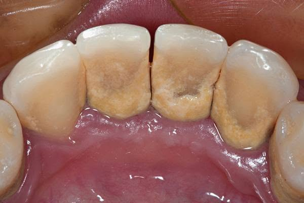 🦷🤍 علاج أسنان مجاني 🤍🦷
السلام عليكم ❤️

 نستقبل مرضى للعلاجات التالية مجاناً ✨

🦷 قلع الاسنان و جذور الأسنان المتبقية
🦷 الحشوات الاعتيادية
🦷 تنظيف الأسنان وإزالة الترسبات
🦷 الأطقم الجزئية المتحركة

📍 المكان: جامعة المشرق – خدمي المطار ✈️

📞 للحجز والاستفسار: ***********

إذا تحتاجون أي علاج من هاي العلاجات أو تعرفون أحد يحتاج، لا تترددون بالتواصل ويانه ❤️

[علما ان العلاج تحت اشراف اطباء مختصين] 

🩷 ابتسامتكم تستاهل العناية! 🦷✨
