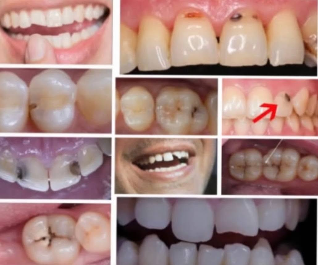 ​«ابتسامتك تستحق الاهتمام.. والعلاج مجاناً بالكامل! 🦷✨»
السلام عليكم جميعاً،
مع بدء العيادات التعليمية، أستقبلكم في العيادة التعليمية لطب وجراحة الفم والأسنان لتقديم أفضل الخدمات الطبية وبأعلى جودة وتحت إشراف كبار الأطباء والأساتذة الاختصاص.
​الخدمات المتوفرة مجاناً:
🔍 فحص وتشخيص أولي كامل للأسنان.
🪥 تنظيف الأسنان وإزالة التكلسات.
🦷 حشوات الأسنان (التجميلية والدائمة).
🦷 قلع الأسنان (حسب الحالة).
🦷 تركيب طقم أسنان (جزئي أو كامل).
💡 تعليمات العناية بصحة الفم والأسنان.
​📍 المكان: العيادة التعليمية - مجمع كليات باب المعظم (كلية أصول الدين).
📞 للحجز والاستفسار: التواصل عبر الخاص أو الرقم التالي (واتساب/اتصال): ***********
​أهلاً وسهلاً بكم دائماً! ❤️

نص مكتوب في الصور:
- ابتسامتك تستحق الاهتمام
- الدكتورة
- THE DOCTOR
- فاطمة قحطان جبر
- الخدمات المتوفرة
- فحص وتشخيص أولي للأسنان
- تنظيف الأسنان وازالة التكلسات
- تعليمات العناية بصحة الفم والأسنان
- حشوات الأسنان
- قلع الأسنان حسب الحالة
- تركيب طقم أسنـان (جزئي أو كامل حسب الحالة)
- العلاج مجاناً
- جميع الإجراءات تحت إشراف دكاترة اختصاص
- للواصل
- ***********
- العيادة التعليمية (مجمع كليات باب معظم) كلية أصول العلم