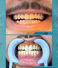✌🏻مميزون 😇💪🏻   ✨ تنضيف الاسنان من جميع   التكلسات بجلسه واحده فقط     ...