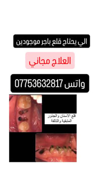 قلع اسنان • علاج مجاني • جذور تالفة