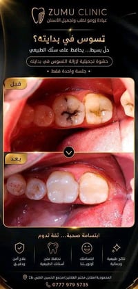 حشوات تجميلية لاسنان اثنين بجلسة واحدة وبنفس لون السن والشكل الطبيعي ١...