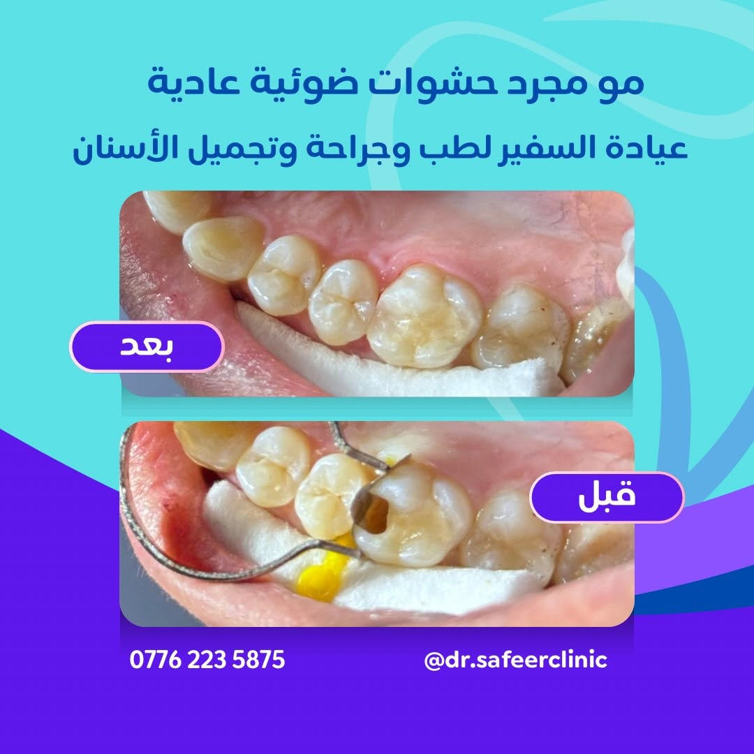 ✨ مو مجرد حشوات ضوئية عادية…
هي عناية بتفاصيل ابتسامتك حتى ترجع أسنانك بشكل صحي وجميل 🤍🦷

من التسوس والتصبغات إلى نتيجة مرتبة وطبيعية ✨
حافظ على أسنانك ولا تنتظر الألم حتى تبدأ العلاج.

📍 عيادة السفير لطب وجراحة وتجميل الأسنان
📞 ***********
📩 للحجز والاستفسار: عـيادة الـسفير

#عيادة_السفير #حشوات_ضوئية #علاج_الاسنان #تجميل_الاسنان #ابتسامة_صحيه

نص مكتوب في الصور:
- مو مجرد حشوات ضوئية عادية
- عيادة السفير لطب وجراحة وتجميل الأسنان
- بعد
- قبل
- ***********
- @dr.safeerclinic
- مو مجرد حشوات ضوئية عادية عيادة السفير لطب وجراحة وتجميل الأسنان بعد قبل *********** @dr.safeerclinic