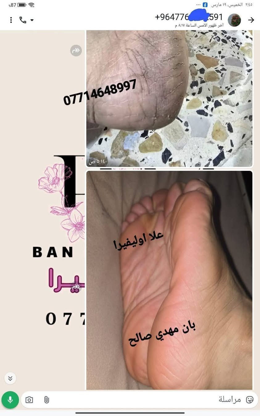 سبب حرارة الصيف واغلبيتنه راح نعاني من تشققات الاقدام وخشونتها بسبب الحراره 😞 ولا يهمكم حبايبي جبتلكم كريم علا اوليفيرا السحري المعجزه بكج كامل 🌟الي راح يخلي اقدامكم نااعمه مثل اقدام الاطفال 💎

نص مكتوب في الصور:
- +964 773 877 *********** شوفى رجلينه كلش جانت يصبن دم والله العضيم ٣ ايام خليته اله العلاج وتعالجن رجليه حتى لايده خليت صارن كلش زينات ***********97
- +964776591
- ***********
- BAN
- علا اوليفيرا!
- بان مهدي صالح
- 077
- مراسلة
- علا اوليفيرا فرع ميسان ***********
- +9647732591 *********** علا اوليفيرا ٠٥:١٧ ص بان مهدي صالح شوفي الفرق ٠٥:٢٢ ص خيه انتي رحمه من الله انطاج النه ايدج وعلاجج بي العافيه ٠٥:٢٣ ص صباح الورد ٠٥:٢٩ ص صلوات عل . محمد هآا . محمد مراسلة
- علا اوليفيرا فرع ميسان *********** هاي قبل العلاج علا اوليفيرا فرع ميسان *********** علا اوليفيرا فرع ميسان *********** هاي بعد االعلاج
- وردة
- نشط الآن
- ٧:٥٩ م
- السلام عليكم
- شخبارج
- حبيت اشوفج الفرق
- ***********
- قبل
- بعد
- علا اوليفيرا فرع ميسان
- ربي يرزقكم ان شاء الله
- ٨:١٩ م
- اللهم صلي على محمد وآل محمد
- لقد قمت بالرد على وردة
- وعليكم السلام ياقلبي
- Aa
- +964 77 2599
- ايي هم نسيت ٠٩:٣٤ م
- ***********
- هاي رجليه اليوم ٠٩:٣٤ م
- بعد استخدام مره وحده ٠٩:٣٥ م
- احسن صار ٠٩:٣٥ م
- صارن ٠٩:٣٥ م
- لصق
- مرحباً! أنا استعمل واتساب. +964 77 علا اوليفيرا فرع ميسان *********** اللهم صلي على محمد وآل محمد اخذت صوره من كلتيلي قبل ماستخدم الخلطه وعلي جان اليل ماينام من الوجع كلساعه يذب عليهن ماي لان يبسن ويشككن بس يدوس بلكاع يطكن دم وعلي نندعيلج وهوه يكول ادعي للمربه لسوتلي رجليه زينات علا اوليفيرا فرع ميسان *********** ياعمري ان شاءالله اكون عند حسن ظنكم يارب ومليون عافيه الكم ياعمري احلى شعور من تراسلوني وانتم فرحانين مراسلة
- علي اولفيرا فرع
- ميسان
- شوفي النتيجه