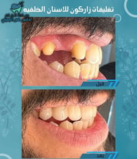 ✌🏻مميزون 😇💪🏻  ✨ تغليف اسنان زاركون  🦷 واعاده تفاصيل            الأسنان...