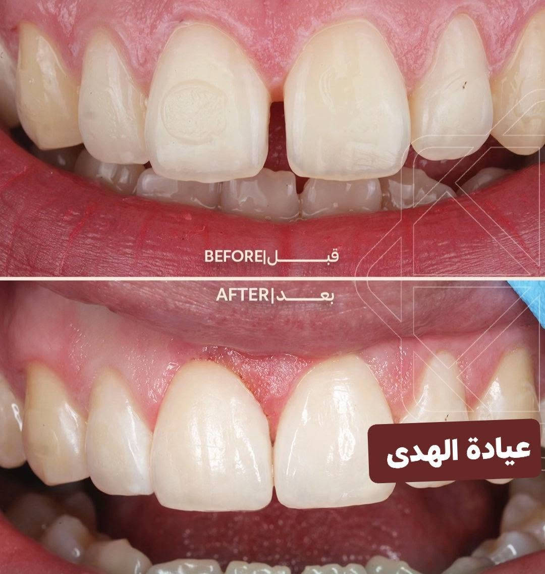 عيادة الهدى لطب الأسنان والتجميل

تقاطع الجدوع مجاور عالم الحليب

***********

اهلا وسهلا بزبائنا الاعزاء

متواجدين يوميا من ٤ عصرا إلى ٩ مساء

نص مكتوب في الصور:
- عيادة الهدى
- BEFORE | قبل AFTER | بعد عيادة الهدى
- BEFORE | قبل
- AFTER | بعد