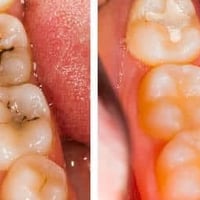 🌹 أني دكتور أسنان، ومتوفّر علاج وشغل مجاني للأشخاص اللي عندهم تسوّس وي...