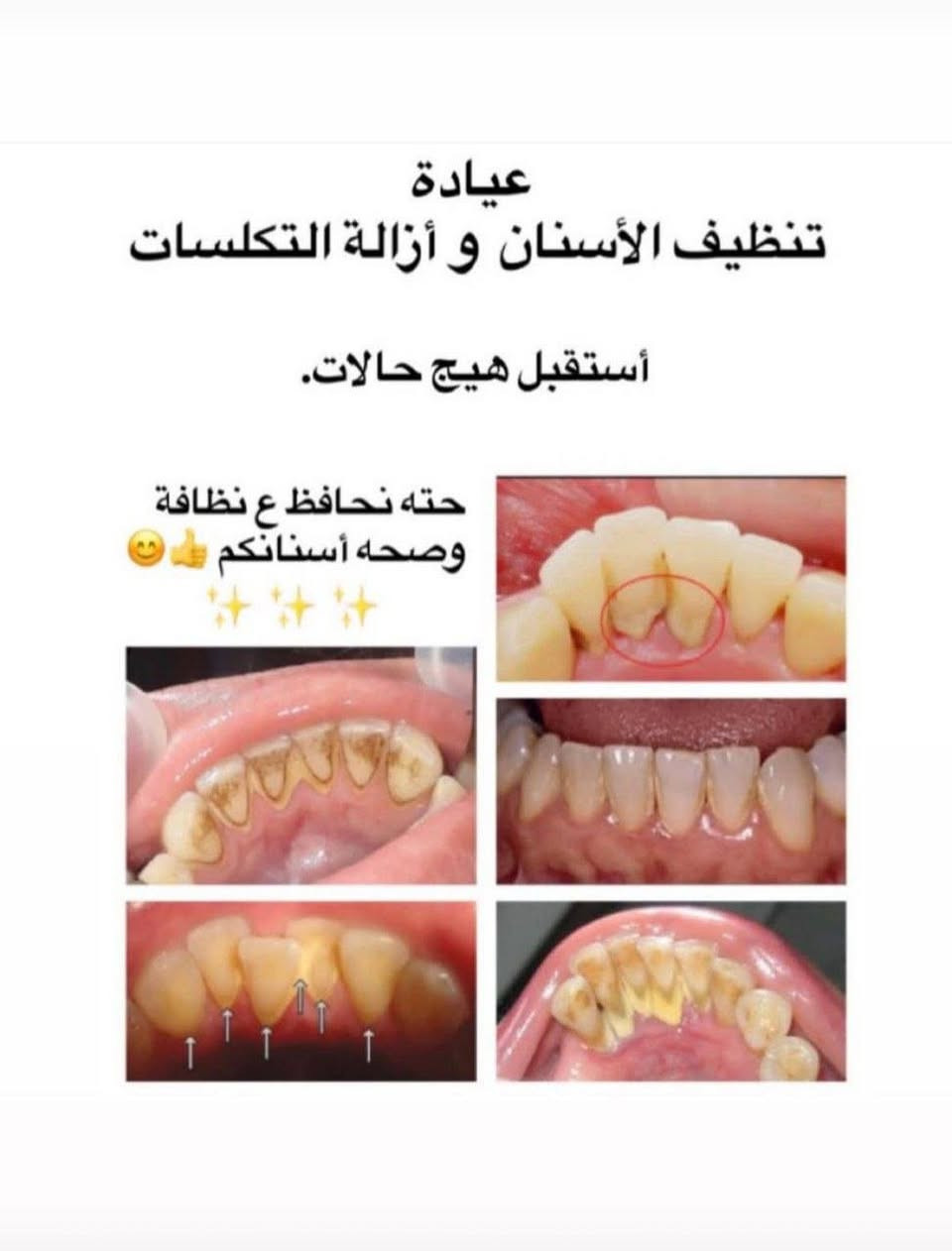 أكو إمكانية للعلاج مجاناً ضمن الحالات المتاحة.
الخدمات المتوفرة: 🦷 حشوات عادية
🦷 قلع الأسنان التالفة والجذور المتبقية
🦷 طقم أسنان جزئي
🦷 تنظيف وإزالة التكلسات
العلاج يتم  في عيادات الجامعةوتحت إشراف الكادر المختص.
📍 بغداد/ شارع فلسطين
📩 إذا حاب/ة تستفسر عن حالتك، راسلنا خاص 🤍
واللي يعرف شخص محتاج، خلي يدزله المنشور 🌷
 للمراسلة واتساب ***********

نص مكتوب في الصور:
- عيادة الحشوات الضوئية (التجميلية )
- أستقبل كل هاي الحالات من التسوس .
- فالي عنده هيج تسوس يتواصل ويانه لأستبدالها بحشوات ضوئية تجميلية ☺️👍
- عيادة الجراحة (القلع) أستقبل هيج حالات .. إذا عندك أسنان تالفة أو بقايا جذور، أو تعرف أحد من عائلتك أو أصدقائك يحتاج علاج، يتواصل ويانه ✨😊✨
- عيادة صناعة الأسنان (تركيب طقم جزئي متحرك) أستقبل هيك حالات.
- عيادة تنظيف الأسنان و أزالة التكلسات أستقبل هيج حالات. حته نحافظ ع نظافة وصحه أسنانكم