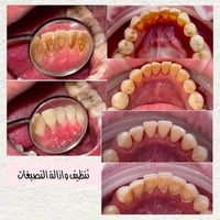 العلاج مجاني • عيادات الاسراء • حشوات تجميلية