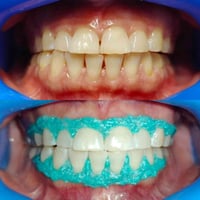 تنظيف اسنان • تبييض بالليزر • تقسيط ماستر
