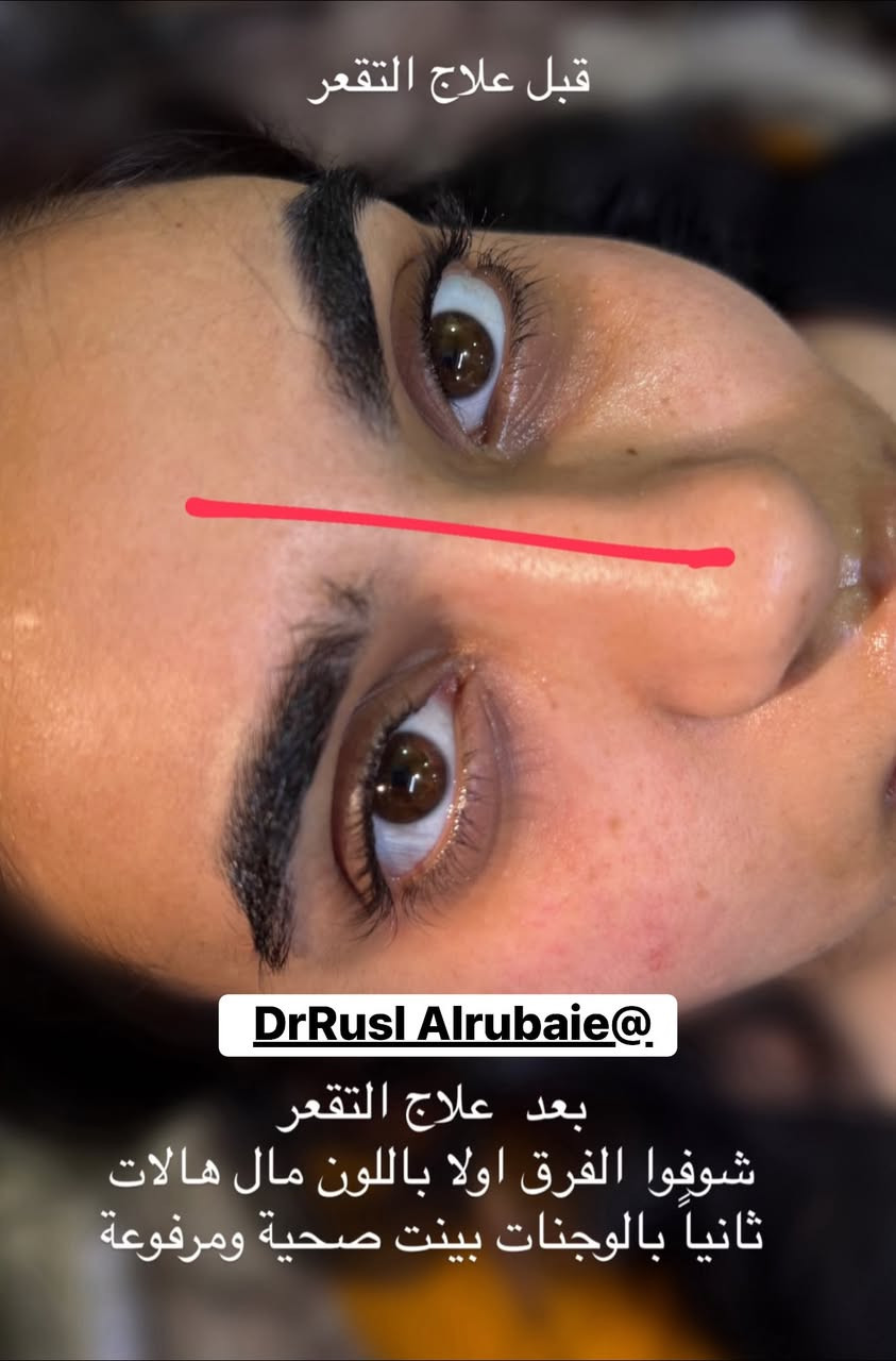 ابر النضارة • فلر شفايف • المسيب